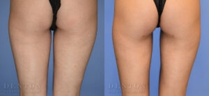 Liposuction B&A 09A