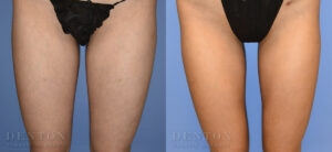 Liposuction B&A 09B