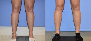 Liposuction B&A 10B