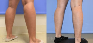 Liposuction B&A 10C