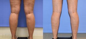 Liposuction B&A 10D