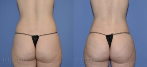 Liposuction B&A 11A