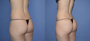 Liposuction B&A 11B