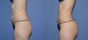 Liposuction B&A 11C