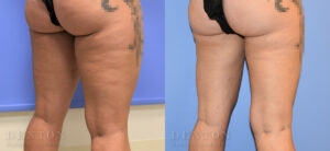 Liposuction B&A 12A