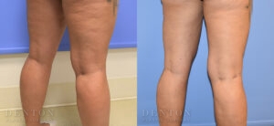 Liposuction B&A 12B