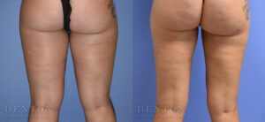 Liposuction B&A 12C