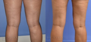 Liposuction B&A 12D