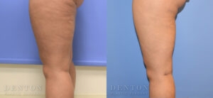 Liposuction B&A 12E