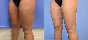 Liposuction B&A 12F