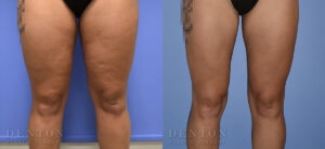 Liposuction B&A 12G