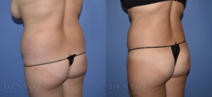 Liposuction B&A 13A