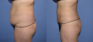 Liposuction B&A 13B