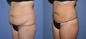 Liposuction B&A 13C