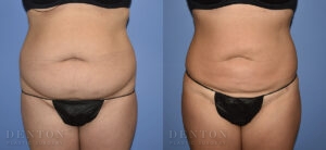 Liposuction B&A 13D