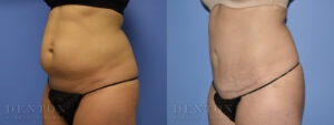 Mini Tummy Tuck B&A Patient 1B