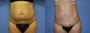 Mini Tummy Tuck B&A Patient 1C