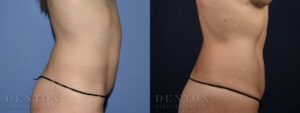 Mini Tummy Tuck B&A Patient 2A