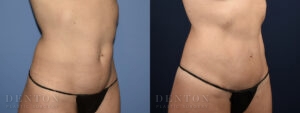 Mini Tummy Tuck B&A Patient 2B