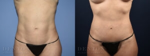 Mini Tummy Tuck B&A Patient 2C