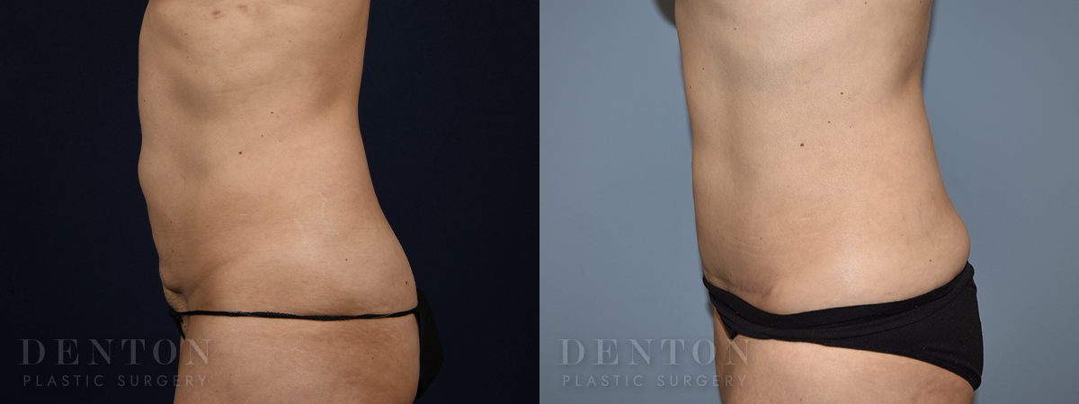 Mini Tummy Tuck Patient 3-A: Before & After