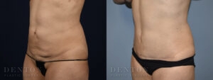 Mini Tummy Tuck B&A Patient 3B