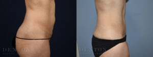 Mini Tummy Tuck B&A Patient 3C