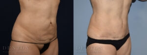 Mini Tummy Tuck B&A Patient 3D