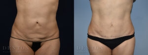 Mini Tummy Tuck B&A Patient 3E